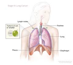 How do health care professionals determine lung cancer staging? Lung Cancer Staging Rocky Mountain Cancer Centers