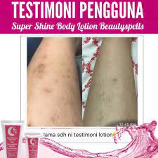Cara cepat menghilangkan bekas kudis yang sudah. Parut Kudis Kulit Sensitif Sume Settled Shopee Malaysia