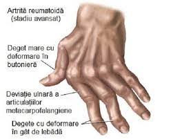 Maybe you would like to learn more about one of these? Artrite Amorteala Degetelor Artroza Mainilor De Ce Apare Si Cum Se Trateaza