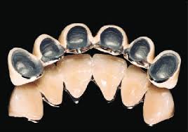 Kirsten ramsay ceramic conse rvation and restoration is an established business based in the united kingdom. Completed Metal Ceramic Restoration Displaying Porcelain Shoulder Download Scientific Diagram