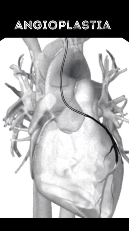 A angioplastia coronariana, também conhecida como intervenção coronariana percutânea (ICP), é um procedimento médico utilizado para abrir artérias coronárias estreitadas ou bloqueadas. Essas artérias ...
