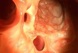 17 Diverticulitis Diverticulosis Symptoms Diagnosis Treatment