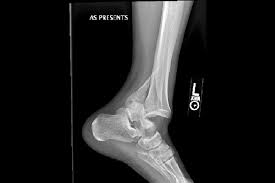 Image result for Ankle Dislocation