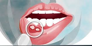 Image result for Canker sores symptoms roof of the mouth