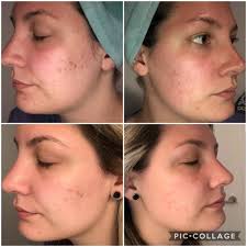 I am an african american teen, 17 and i need help with my acne marks. Hyperpigmentation Skincare Products That People Swear By