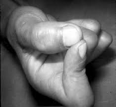 La Mano Dormida Por Compresiones Nerviosas
