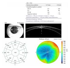 Corneal Pachymetry Of A Patient With Keratoconus Generated