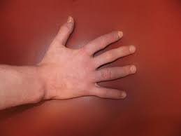 Lupus did not affect my hands. A Unique Presentation Of Lupus Erythematosus Tumidus In An Adolescent Boy Mdedge Dermatology