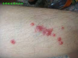 紅螞蟻咬傷- 黃輝鵬皮膚科診所黃輝鵬皮膚科診所