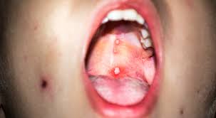 Image result for Canker sores symptoms roof of the mouth