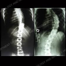 It is the most common location for scoliosis curves, and often includes deformity of the rib cage and spine. Scoliosis In Adults What To Know About Symptoms Treatment