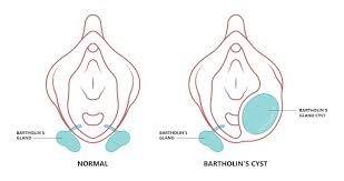 Image result for Bartholin's gland abscess