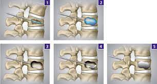 Elastoplastie Stabilisierung Von Gebrochenen Wirbeln Bei Osteoporose Gelenk Klinik De