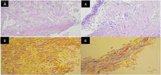 Itunes 8 is officially available for download from apple's servers. A A Low Power View Showed Morphous Material In Keeping With Amyloid Download Scientific Diagram