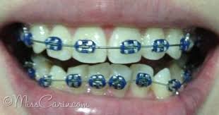 Pin On Braces Color Ideas