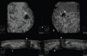 What does breast cancer look like? Automatic Breast Ultrasound State Of The Art And Future Perspectives Ecancer