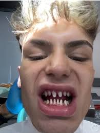 My £3k Turkey teeth made me look like a shark