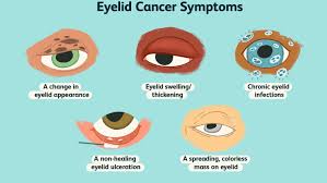 According to the american cancer society, just over 100,000 new cases of skin cancer are diagnosed in the united states each year. Eyelid Cancer Overview And More