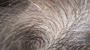 Have the person who has the head lice wear a shower cap or stay in a small. Does Hair Dye Kill Lice Or Their Eggs Complete Guide