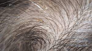 For head lice removal, using hair dye just isn't the way forward. Does Hair Dye Kill Lice Or Their Eggs Complete Guide