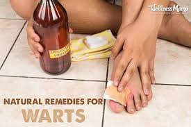how to get rid of warts naturally