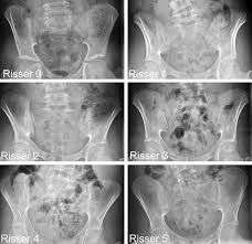 Image result for Risser Sign