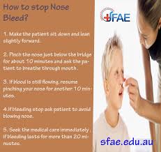 How To Stop Nose Bleed Http Www Sfae Edu Au Stop Nose Bleeds First Aid Treatment Nose Bleeds