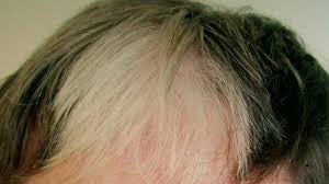 Hair grows everywhere on the human skin except on places like the palms of our hands and the soles of our feet, our eyelids and belly buttons alopecia areata often starts suddenly and causes patchy hair loss in children and young adults. White Hair Causes And Prevention