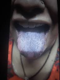 Image result for black tongue symptoms