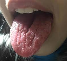 Image result for Fissured tongue