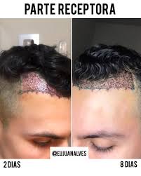 Estive crescendo meu cabelo por 5 anos, hoje eu cortei para doar. Implante Capilar Preco