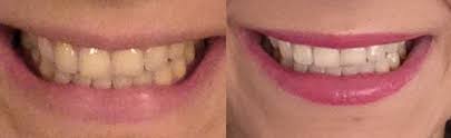 Entfernen sie rote augen, werden sie akne und falten los und weißen sie die zähne! Bleaching Zahne Bleichen So Gelingt Die Zahnaufhellung Brigitte De