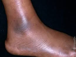 Image result for erythema nodosum