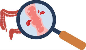 Image result for Small Intestinal Bleeding