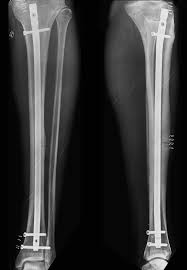 Image result for Tibia Stress Fracture