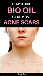 Bio Oil Before And After Scars Pin On Acne Remedies For Scars