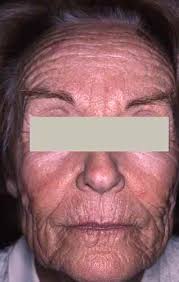 Facile et rapide à réaliser, goûteuse et diététique. Vieillissement De La Peau Solution Contre Le Vieillissement De La Peau Et Les Rides Dermatologue En Ligne