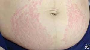 Image result for pruritic urticarial papules and plaques of pregnancy