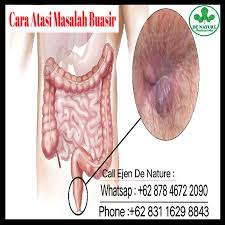 Sila layari www.almuslihinherbs.com untuk maklumat lanjut. Pembedahan Buasir Dan Cara Berurusan Dengan Buasir Ubat Herba Indonesia