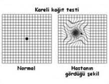 makula dejenerasyonu yasa bagli makula dejenerasyonu 60 yas uzerindekilerde gorme kaybinin en sik sebeplerinden birisidir bu hastalik gozun arka kis yastiklar