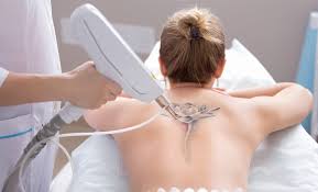 The tattooed skin is cut out and the surrounding skin is sewn back together. How Soon Can Get Tattoo Removed Fairview Cosmetics Surgery