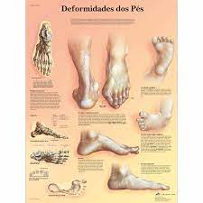 Deformidades dos Pés 