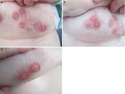 Image result for zoster under breasts