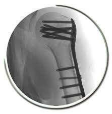 Omuz Kiriklari Op Dr Taner Bekmezci