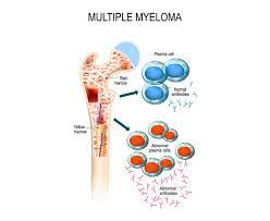 Often, no symptoms are noticed initially. Multiple Myeloma Diag2tec Preclinical Cro In Mm