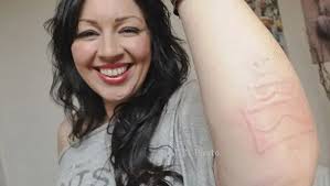 KISAH UNIK : Kulit Sensitif, Wanita Ini Bisa Bikin Pola di Tangan