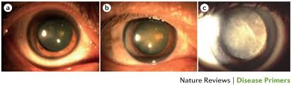 Cataract symptoms cataracts currently affect over 22 million americans who are 40 or older, and as the population. Cataract Nature Reviews Disease Primers