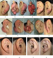 Hypertrophic scars are more common than keloids. Keloids And Hypertrophic Scars Can Now Be Treated Completely By Multimodal Therapy Including Surgery Followed By Radiation And Corticosteroid Tape Plaster Intechopen