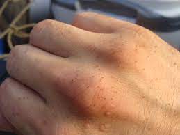Seed Tick Turkey Mite Season Underway Kentucky Pest News