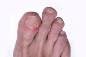 Improper nail trimming usually means that you are cutting too short. How To Prevent And Treat Ingrown Toenails Health Essentials From Cleveland Clinic